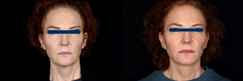 Before and After Face & Neck Lift at Face Works Plastic Surgery Near Me in Schaumburg, IL