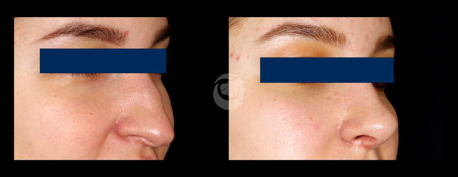 Before and After Nose Plastic Surgery at Face Works Plastic Surgery, Near Me in Schaumburg, IL