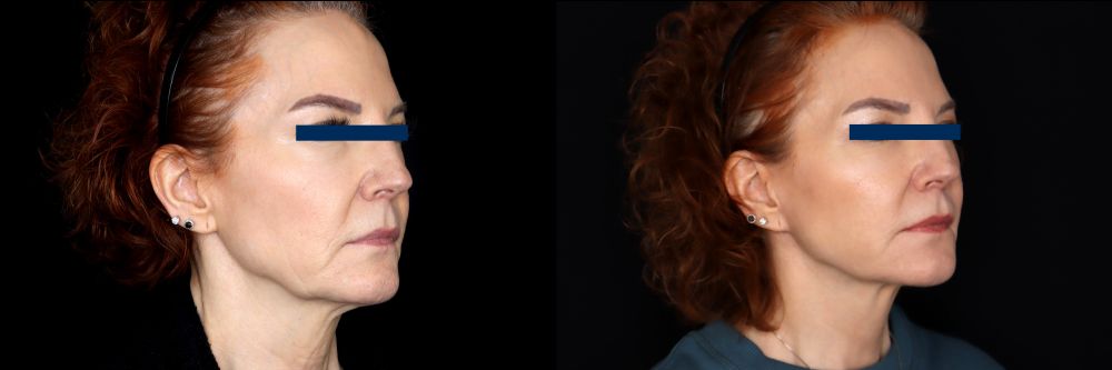 Before and After Face & Neck Lift at Face Works Plastic Surgery Near Me in Schaumburg, IL
