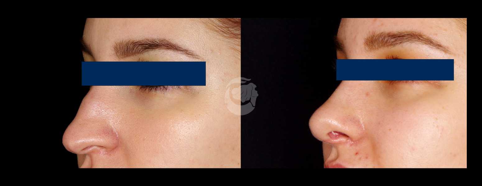 Before and After Nose Plastic Surgery at Face Works Plastic Surgery, Near Me in Schaumburg, IL