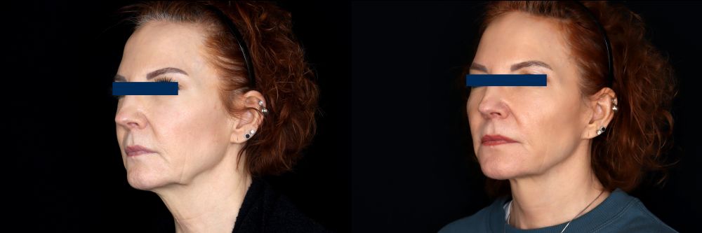 Before and After Face & Neck Lift at Face Works Plastic Surgery Near Me in Schaumburg, IL