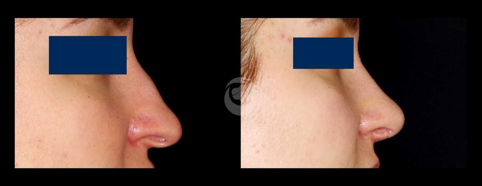 Before and After Nose Plastic Surgery at Face Works Plastic Surgery, Near Me in Schaumburg, IL