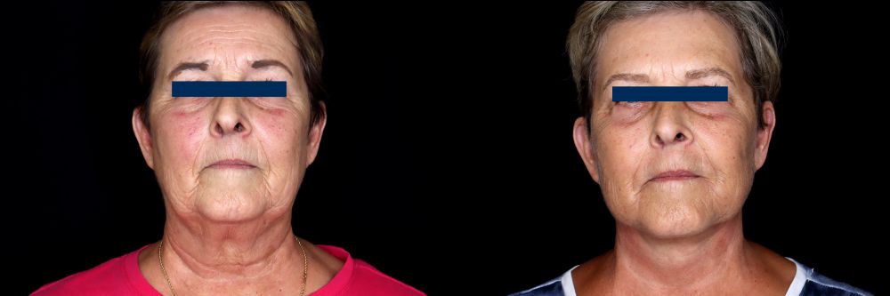 Before and After Face & Neck Lift at Face Works Plastic Surgery Near Me in Schaumburg, IL