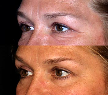 Before and After Eyelids Plastic Surgery at Face Works Plastic Surgery, Near Me in Schaumburg, IL