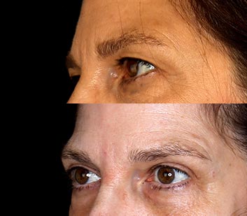 Before and After Eyelids Plastic Surgery at Face Works Plastic Surgery, Near Me in Schaumburg, IL