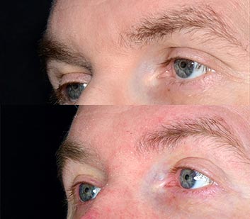 Before and After Eyelids Plastic Surgery at Face Works Plastic Surgery, Near Me in Schaumburg, IL