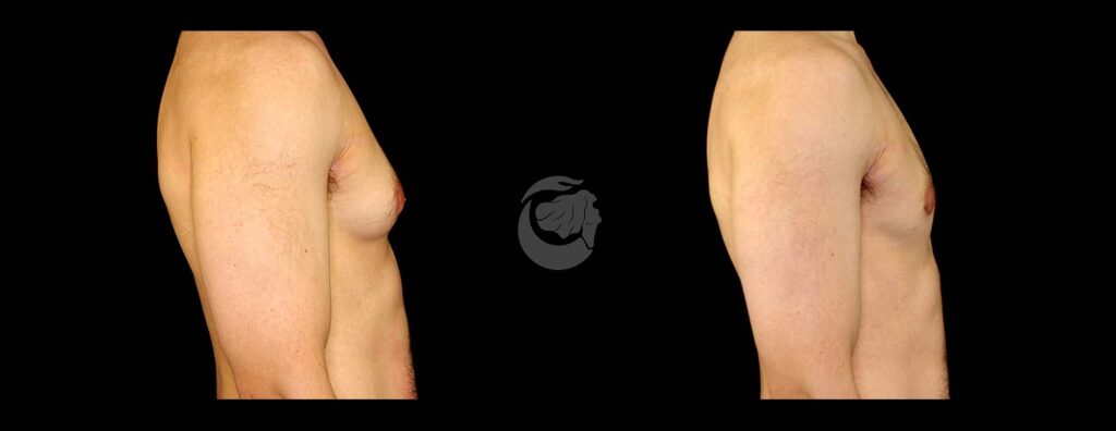 Before and After Gynecomastia at Face Works Plastic Surgery, Plastic Surgeon Near Me in Schaumburg, IL
