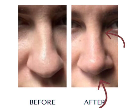 Before and After Nose Plastic Surgery at Face Works Plastic Surgery, Near Me in Schaumburg, IL