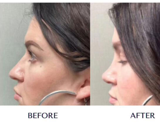 Before and After Nose Plastic Surgery at Face Works Plastic Surgery, Near Me in Schaumburg, IL