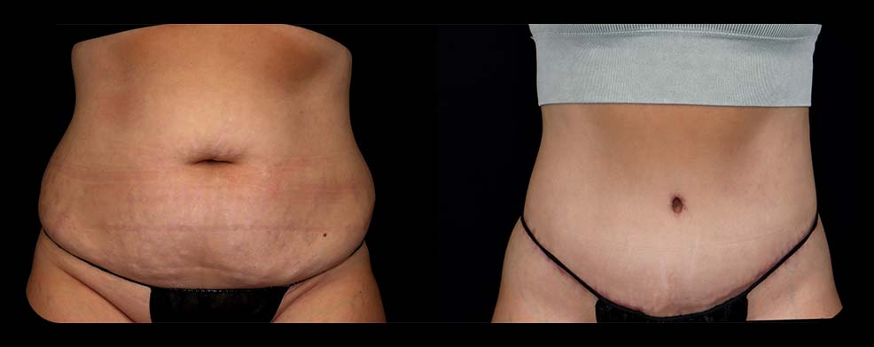 Before and After Tummy Tuck at Face Works Plastic Surgery, Plastic Surgeon Near Me in Schaumburg, IL