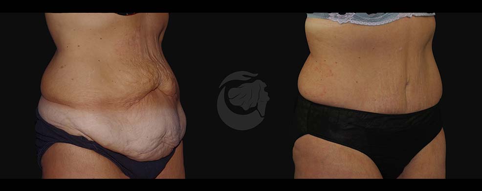Before and After Tummy Tuck at Face Works Plastic Surgery, Plastic Surgeon Near Me in Schaumburg, IL