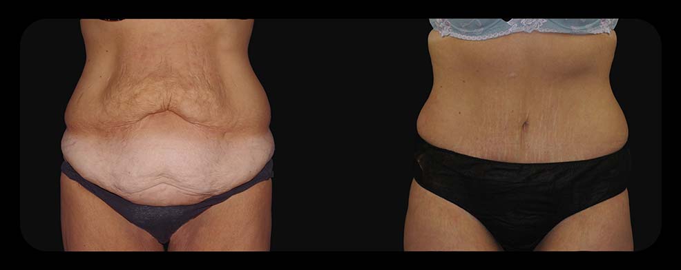 Before and After Tummy Tuck at Face Works Plastic Surgery, Plastic Surgeon Near Me in Schaumburg, IL