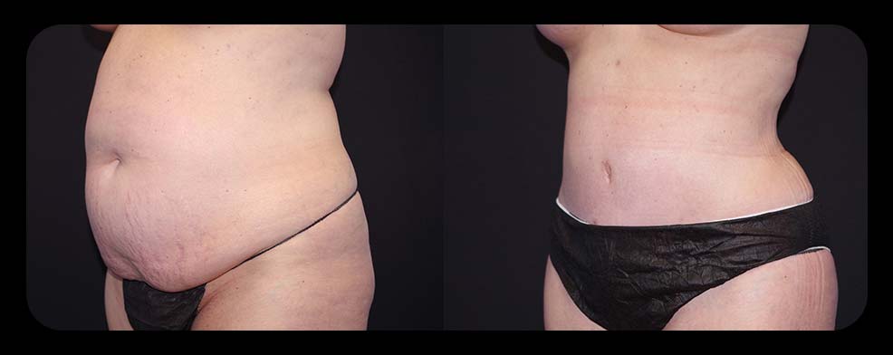 Before and After Tummy Tuck at Face Works Plastic Surgery, Plastic Surgeon Near Me in Schaumburg, IL