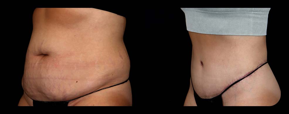 Before and After Tummy Tuck at Face Works Plastic Surgery, Plastic Surgeon Near Me in Schaumburg, IL