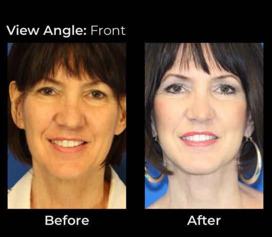 Before and After Eyelids Plastic Surgery at Face Works Plastic Surgery, Near Me in Schaumburg, IL