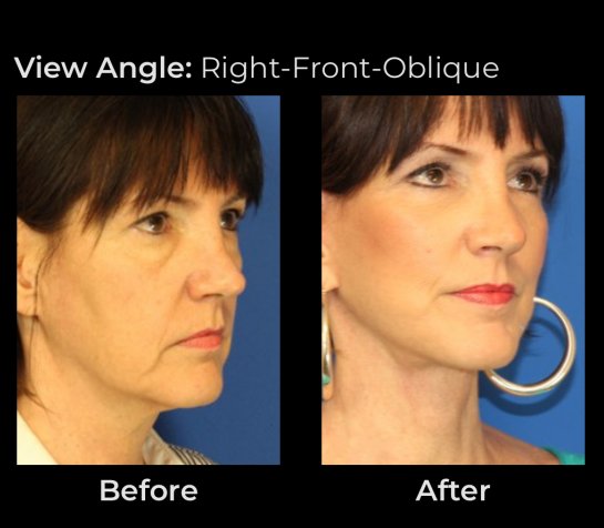 Before and After Eyelids Plastic Surgery at Face Works Plastic Surgery, Near Me in Schaumburg, IL