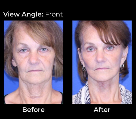 Before and After Eyelids Plastic Surgery at Face Works Plastic Surgery, Near Me in Schaumburg, IL