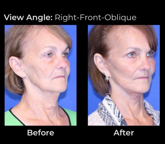 Before and After Eyelids Plastic Surgery at Face Works Plastic Surgery, Near Me in Schaumburg, IL