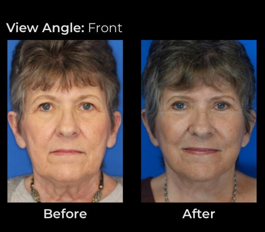 Before and After Eyelids Plastic Surgery at Face Works Plastic Surgery, Near Me in Schaumburg, IL