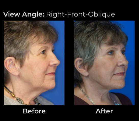 Before and After Eyelids Plastic Surgery at Face Works Plastic Surgery, Near Me in Schaumburg, IL