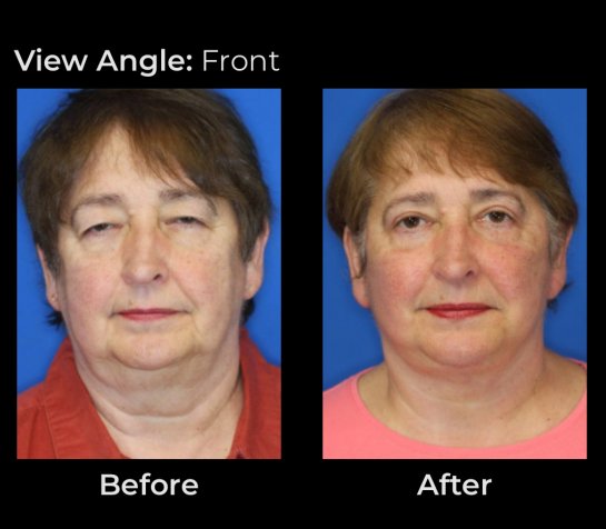 Before and After Eyelids Plastic Surgery at Face Works Plastic Surgery, Near Me in Schaumburg, IL