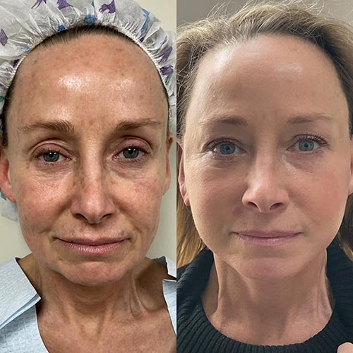 Before and After Face & Neck Lift at Face Works Plastic Surgery Near Me in Schaumburg, IL