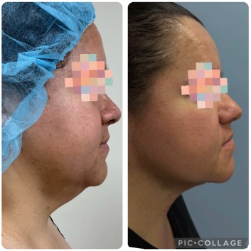 Before and After HD LipoX® of Jawline at Face Works Plastic Surgery, Plastic Surgeon Near Me in Schaumburg, IL