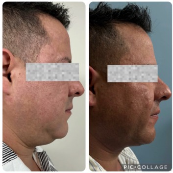Before and After HD LipoX® of Jawline at Face Works Plastic Surgery, Plastic Surgeon Near Me in Schaumburg, IL