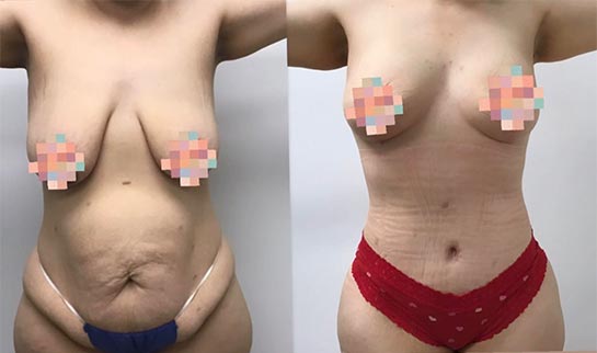 Before and After Breast Augmentation - Lift at Face Works Plastic Surgery, Plastic Surgeon Near Me in Schaumburg, IL