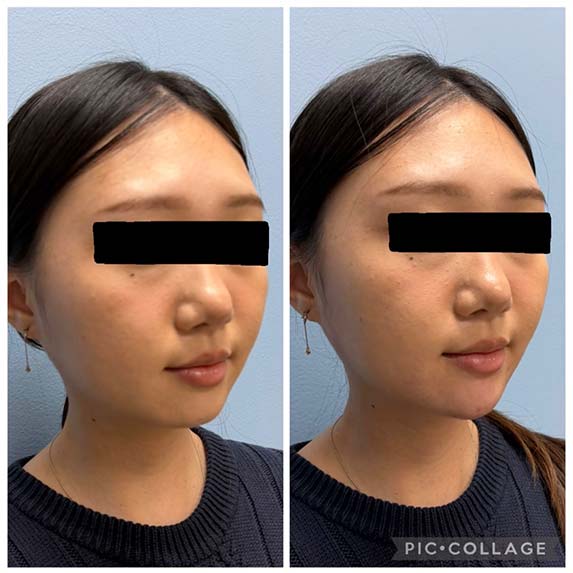 Chin Filler/Implant at Face Works Plastic Surgery, Near Me in Schaumburg, IL