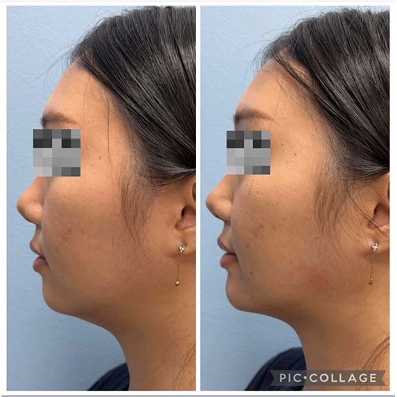 Chin Filler/Implant at Face Works Plastic Surgery, Near Me in Schaumburg, IL