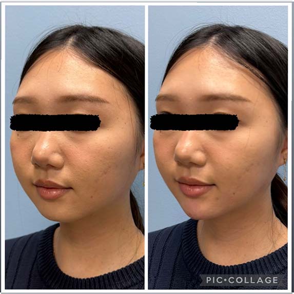 Chin Filler/Implant at Face Works Plastic Surgery, Near Me in Schaumburg, IL