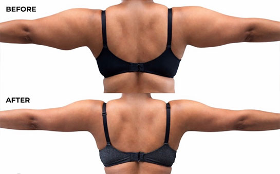 HD Arm Lipo 360 Specialist Serving Chicago, Schaumburg, IL