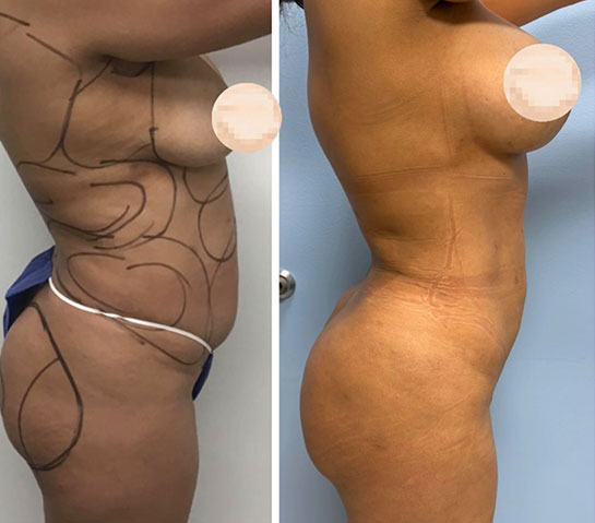 Before and After Body Liposuction at Face Works Plastic Surgery, Near Me in Schaumburg, IL