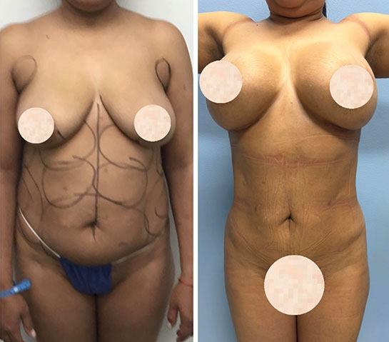 Before and After Body Liposuction at Face Works Plastic Surgery, Near Me in Schaumburg, IL