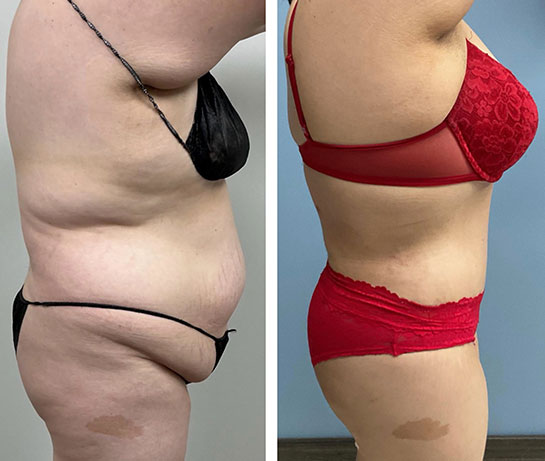 Before and After Mommy Makeover at Face Works Plastic Surgery, Plastic Surgeon Near Me in Schaumburg, IL