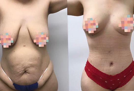 Tummy Tuck at Face Works Plastic Surgery, Plastic Surgeon Near Me in Schaumburg, IL