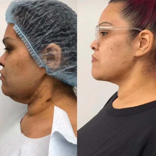 Before and After Face & Neck Lift at Face Works Plastic Surgery Near Me in Schaumburg, IL
