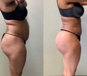Before and After Body Liposuction at Face Works Plastic Surgery, Near Me in Schaumburg, IL