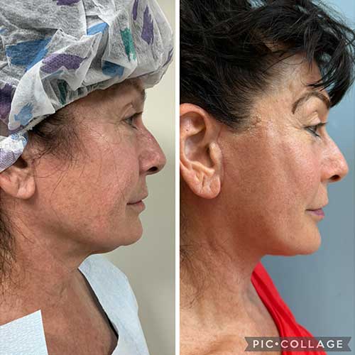 Before and After Face & Neck Lift at Face Works Plastic Surgery Near Me in Schaumburg, IL