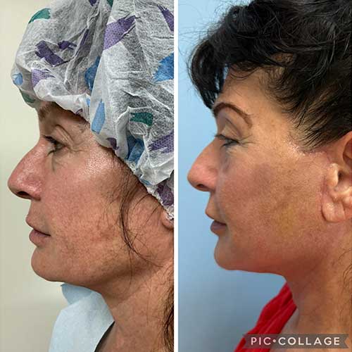 Before and After Face & Neck Lift at Face Works Plastic Surgery Near Me in Schaumburg, IL