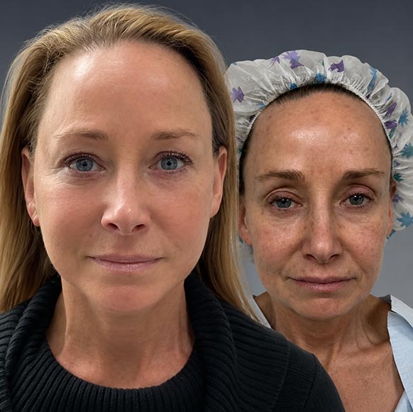 Face Lift at Face Works Plastic Surgery, Plastic Surgeon Near Me in Schaumburg, IL Face Lift at Face Works Plastic Surgery, Plastic Surgeon Near Me in Schaumburg, IL