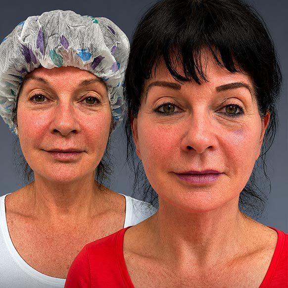 Face Lift at Face Works Plastic Surgery, Plastic Surgeon Near Me in Schaumburg, IL Face Lift at Face Works Plastic Surgery, Plastic Surgeon Near Me in Schaumburg, IL