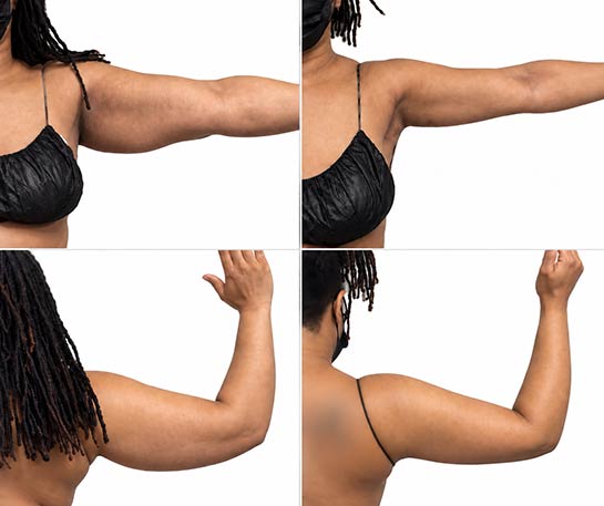 Before and After Arms Plastic Surgery at Face Works Plastic Surgery, Near Me in Schaumburg, IL