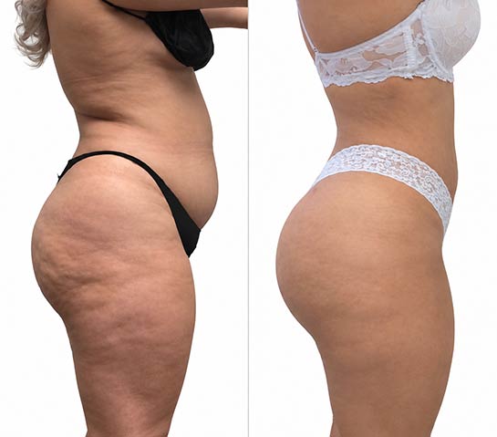 Before and After Brazilian Butt Lift ( Fat Transfer or Liquid) at Face Works Plastic Surgery, Plastic Surgeon Near Me in Schaumburg, IL