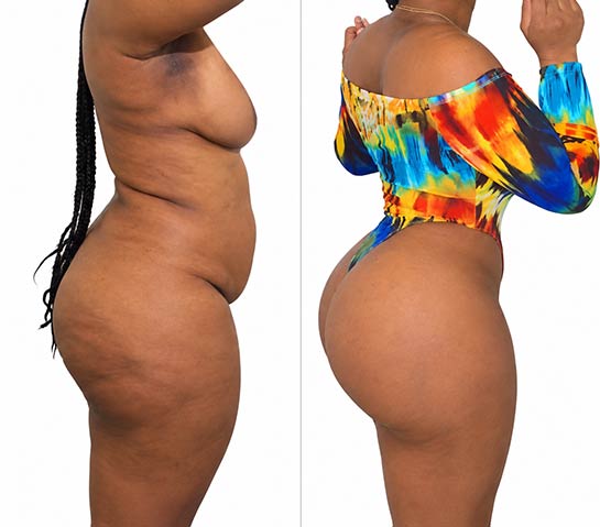 Before and After Brazilian Butt Lift ( Fat Transfer or Liquid) at Face Works Plastic Surgery, Plastic Surgeon Near Me in Schaumburg, IL