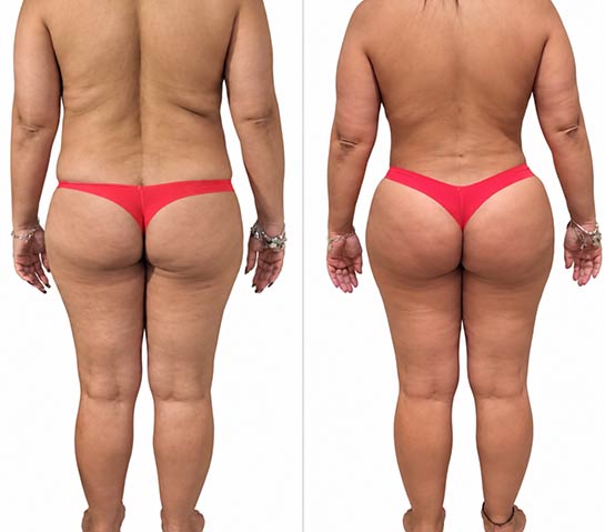 Before and After Brazilian Butt Lift ( Fat Transfer or Liquid) at Face Works Plastic Surgery, Plastic Surgeon Near Me in Schaumburg, IL