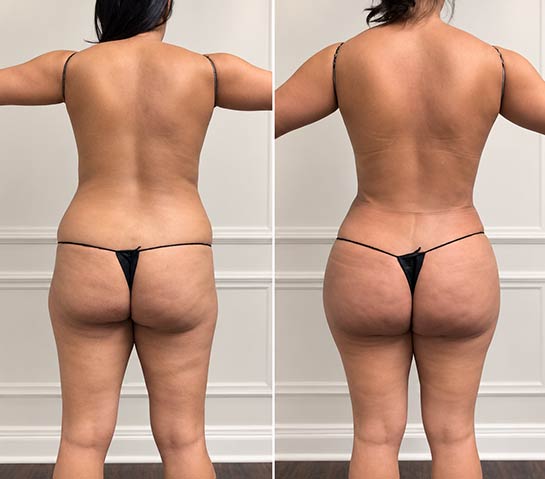 Before and After Brazilian Butt Lift ( Fat Transfer or Liquid) at Face Works Plastic Surgery, Plastic Surgeon Near Me in Schaumburg, IL