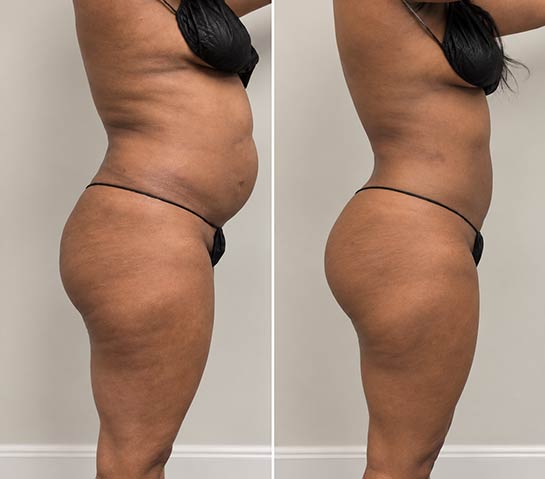 Before and After Brazilian Butt Lift ( Fat Transfer or Liquid) at Face Works Plastic Surgery, Plastic Surgeon Near Me in Schaumburg, IL