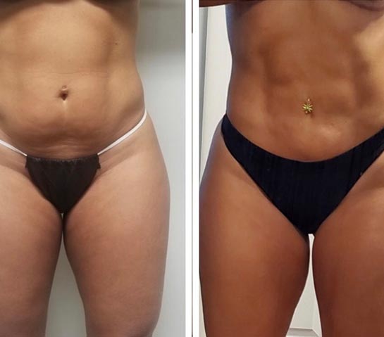 Before and After Body Liposuction at Face Works Plastic Surgery, Near Me in Schaumburg, IL